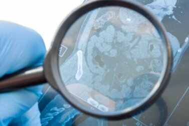 O que é uma fístula gastrointestinal e o que a provoca?