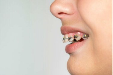O que é uma sobremordida, causas e como tratá-la