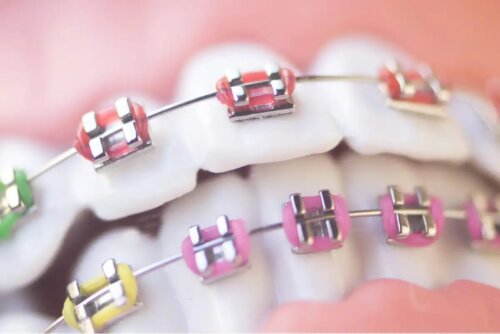 Aparelho nos dentes