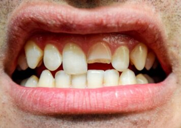Traumatismo dentário: o que é e quais tipos existem?