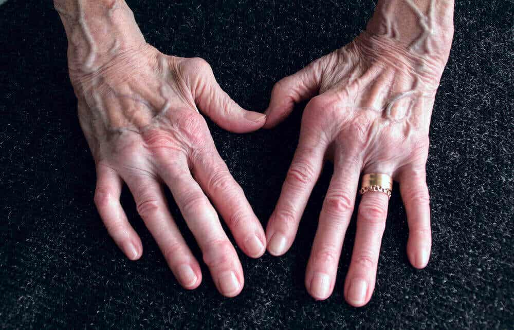 Artrite reumatoide