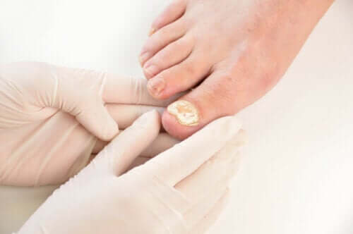 7 maneiras de prevenir a micose nas unhas