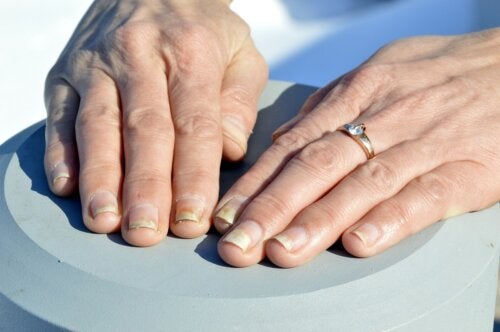 Como cuidar das unhas com psoríase?