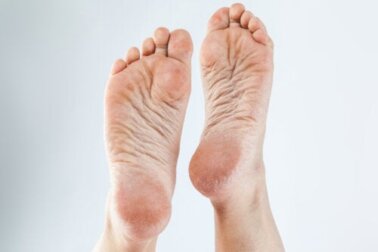 3 cremes naturais para remover calos dos pés