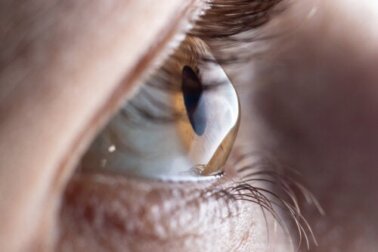 Paquimetria: o que caracteriza este exame e como ele é feito?