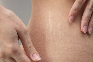 6 receitas caseiras para atenuar as estrias