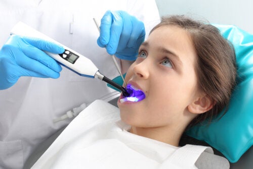 O que são selantes dentais e para que eles servem?