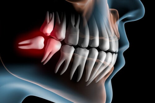 O que são dentes do siso impactados e qual o tratamento?