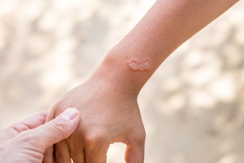 Os 8 melhores remédios naturais para eliminar fungos na pele