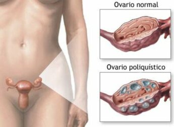 Tratamento natural para a síndrome dos ovários policísticos