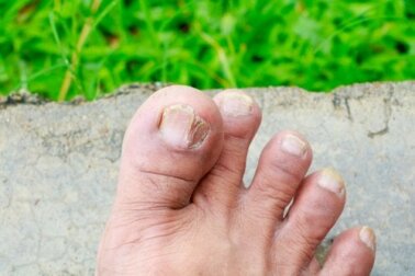 5 tipos de fungos na pele e como identificá-los