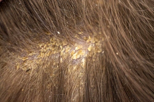 Por que aparecem placas no couro cabeludo? 13 causas possíveis