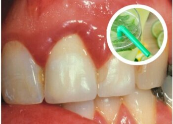 Enxaguantes caseiros eficazes para tratar o sangramento das gengivas