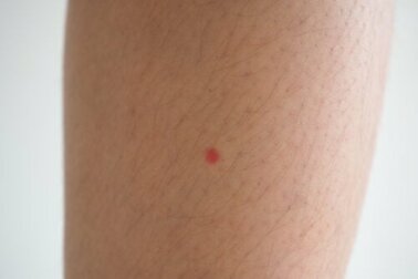 Manchas vermelhas nas pernas: a que se devem e o que posso fazer a respeito?