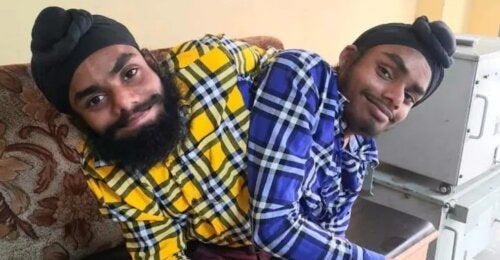 Eles poderão deixar o orfanato: gêmeos siameses foram contratados e ganharão dois salários