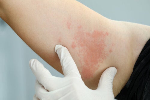 Infecções de pele: tipos, causas e tratamentos