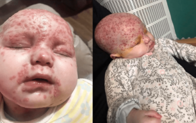 Bebê de seis meses contrai herpes por beijo