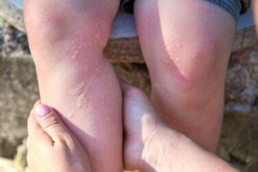 Urticária: tipos, causas e prevenção