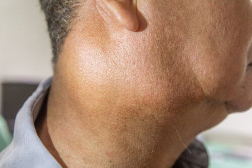 Infecção das glândulas salivares: causas e tratamentos