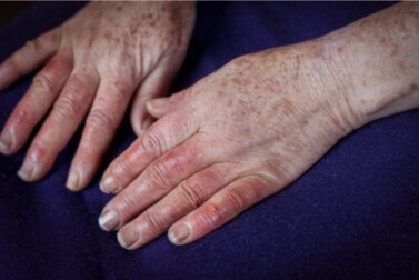 Doença de Buerger: sintomas, causas e tratamentos