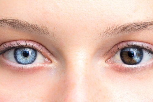 O que é heterocromia e quais são seus tipos?