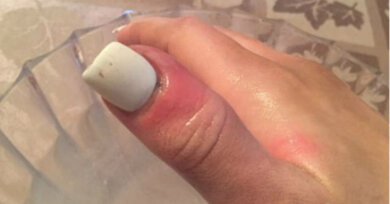 Modelo americana desenvolve câncer embaixo da unha de gel