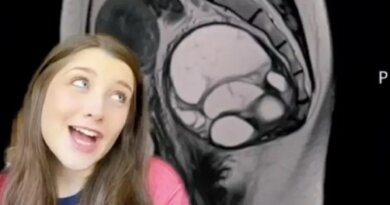 Jovem com dor nas costas descobre tumor do “tamanho da cabeça de um bebê”