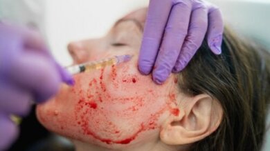 Vampire facial: o que é e quais são seus riscos
