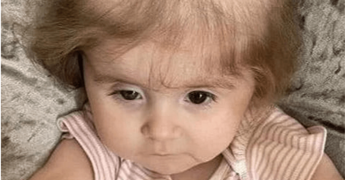 Por causa de doença rara, menina de apenas 2 anos começa a arrancar e comer o próprio cabelo