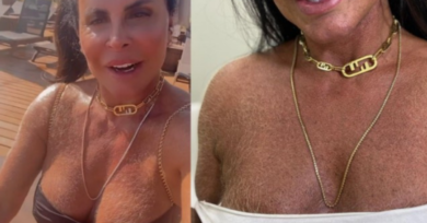 Após polêmica por Gretchen aparecer nas redes com peito e braços peludos, médico explica as causas desse fenômeno