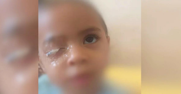 Criança de 2 anos gruda o olho com cola instantânea