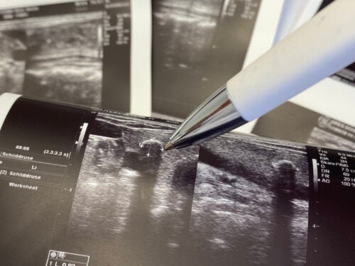 Nódulo hipoecoico: o que é e como identificá-lo?