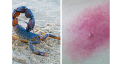 O que fazer em caso de picada de escorpião