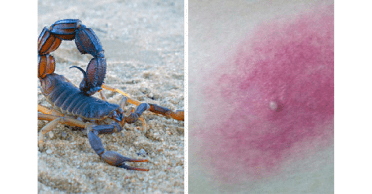 O que fazer em caso de picada de escorpião