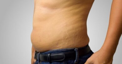 Estrias nos homens: causas e como reduzi-las naturalmente