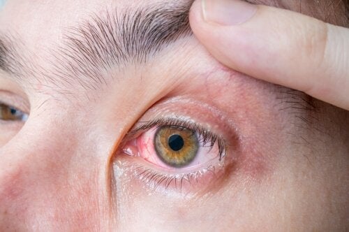 Melanoma ocular: sintomas e causas