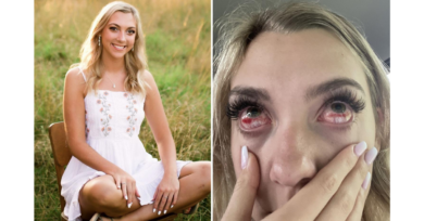 Adolescente fica com “olhos de zumbi” após extensão de cílios