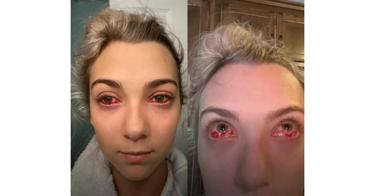 Adolescente fica com “olhos de zumbi” após extensão de cílios