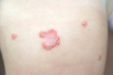 Impetigo em crianças