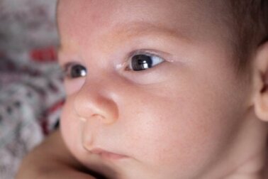 Aniridia ou ausência da íris: o que é e por que ocorre?