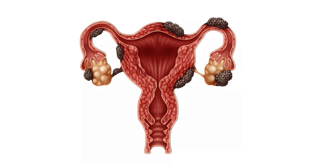 Endometriose: conheça a doença que afeta a cantora Anitta