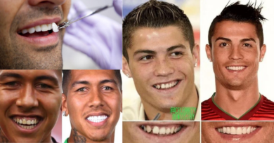 Conheça os riscos das lentes de contato dentais que são moda entre jogadores de futebol e famosos