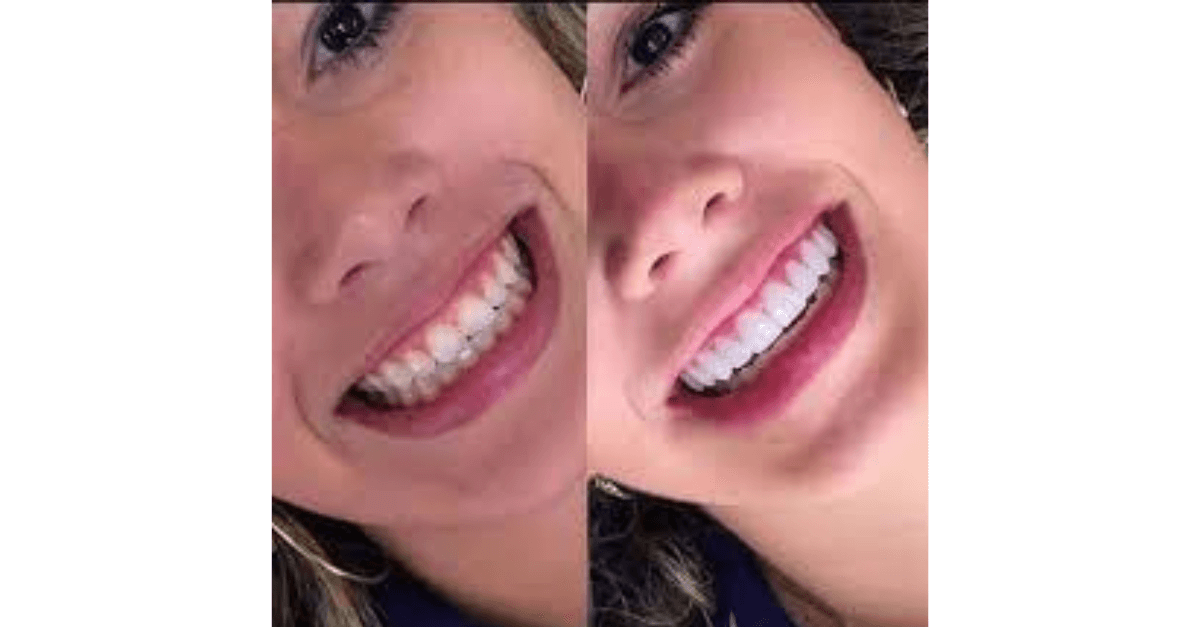 Conheça os riscos das lentes de contato dentais que são moda entre jogadores de futebol e famosos