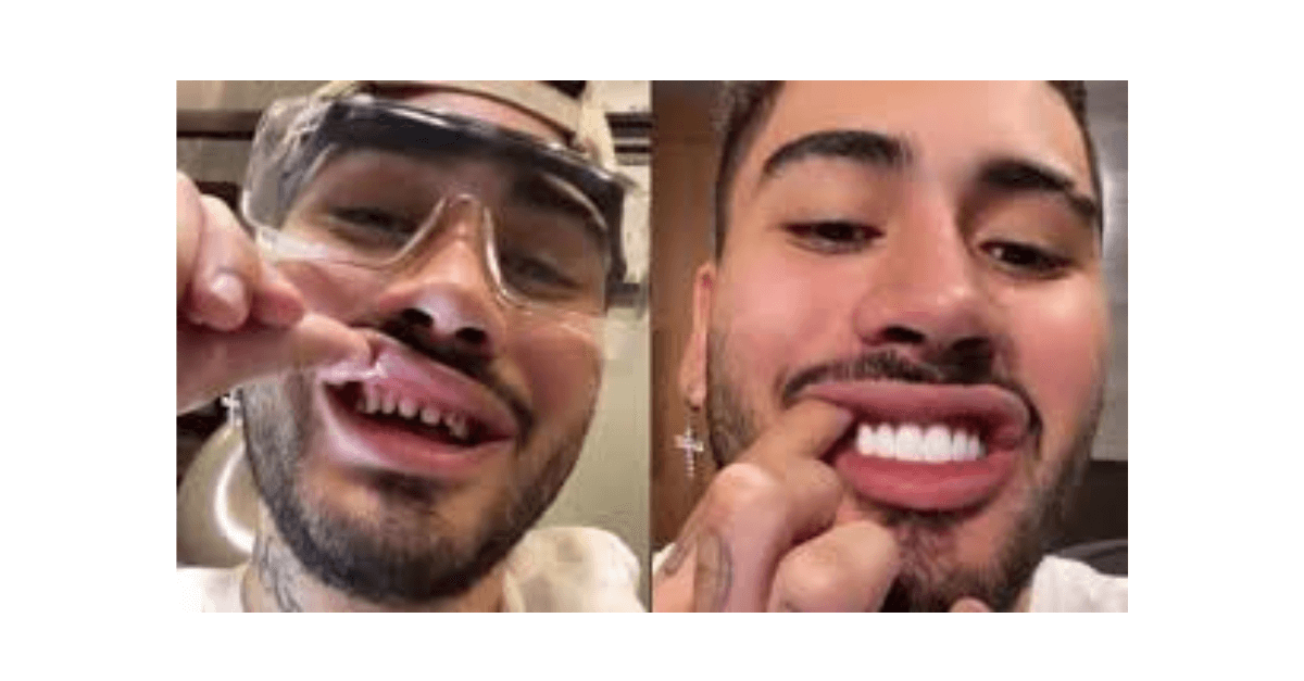 Conheça os riscos das lentes de contato dentais que são moda entre jogadores de futebol e famosos