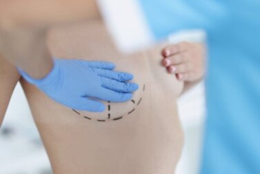 Mastopexia: benefícios e riscos de levantar os seios