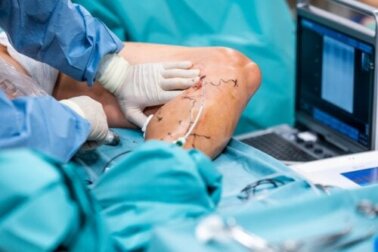 Cirurgia endolaser para varizes: em que consiste e quais são seus benefícios