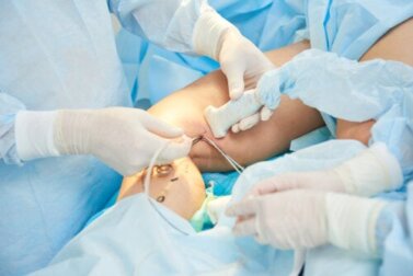 Escleroterapia de varizes: como é feita?