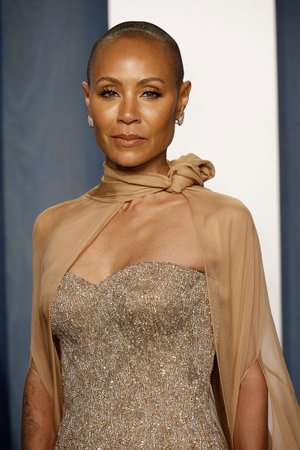 alopecia feminina