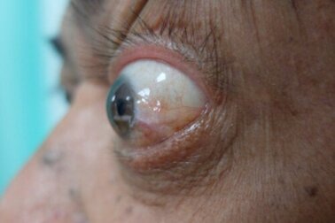 Orbitopatia tiroideia: sintomas, tratamentos e recomendações