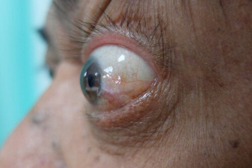 Orbitopatia tiroideia: sintomas, tratamentos e recomendações